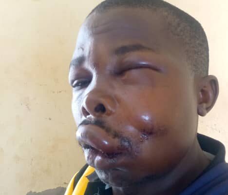 Officer Moîse Nkurunziza who was beaten up by angry Buganda residents, DR